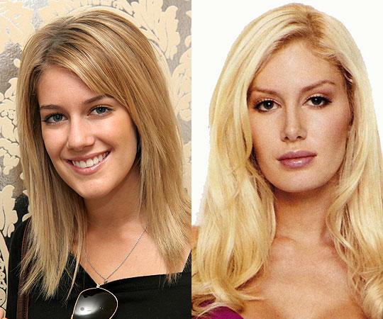 Heidi Montag  krūšu implanti... Autors: UglyPrince Plastiskā ķirurģija