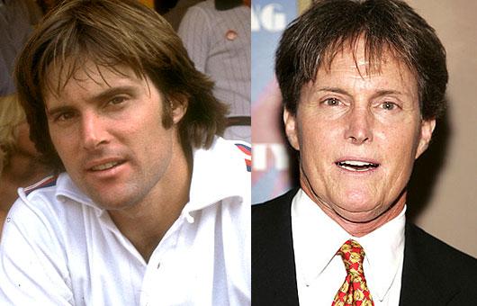 Bruce Jenner deguna korekcija... Autors: UglyPrince Plastiskā ķirurģija