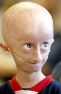 Progeriaslimībakuru izraisa... Autors: augsina Pasaules dīvainākās slimības.
