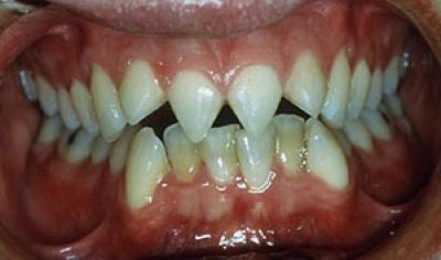 Tooth FilingZobu apvīlēšana... Autors: augsina Citāds ķermenis