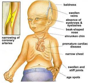 Simptomi Īpatnis ir īsa auguma... Autors: Fosilija Progeria - Mirsti Jauns!