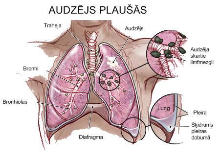 Vēzis ir sen zināma slimība... Autors: Aizliegtais auglis Dažādas slimības - otrā daļa: Vēzis un Audzējs