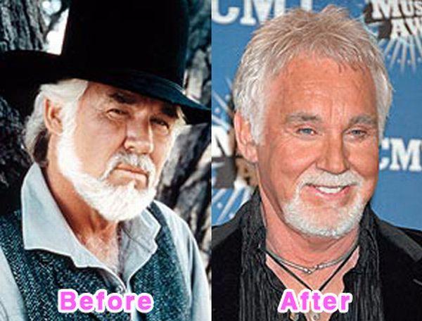 Kenny Rogers Autors: bee62 16 Worst Celebrity Plastic Surgery Disasters part 1