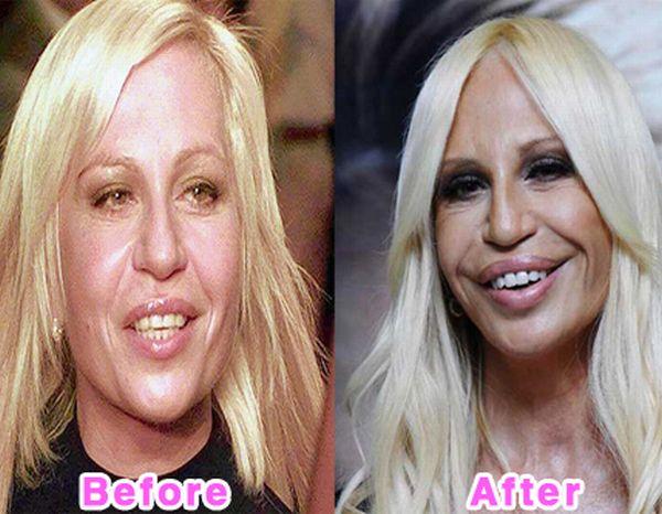 Donatella Versace Autors: bee62 16 Worst Celebrity Plastic Surgery Disasters part 1