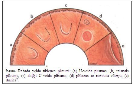 Perifēras tīklenes... Autors: roberts1144 Tīklenes patoloģija