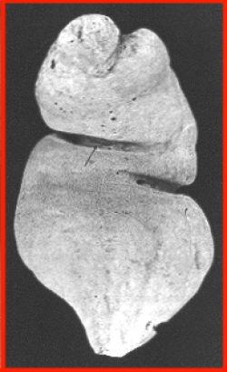 Cementa un klizmas... Autors: anjelka Trakākie priekšmeti, kas atrasti cilvēka ķermenī