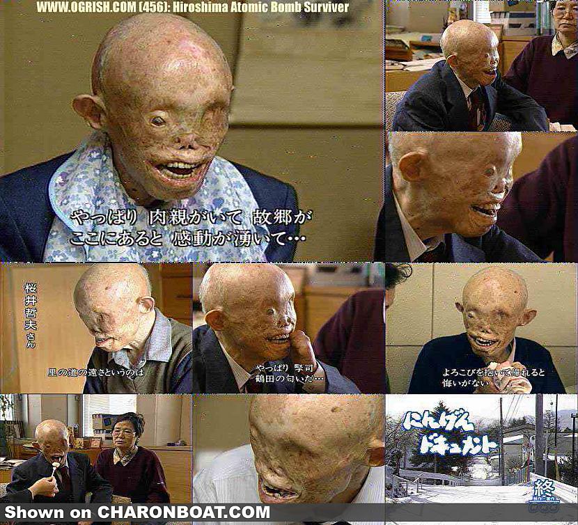 Radiācijas sekas Autors: KristiansFeldmanis Hirošima, 66 gadi pēc atomsprādziena