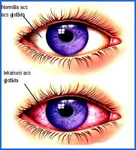 Sarkanu aci rada acs... Autors: bubina696 Dažas izplatītākās acu slimības