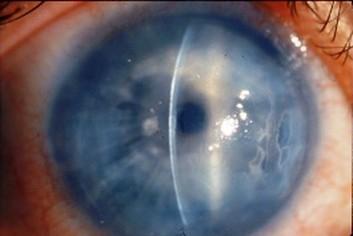 Glaukoma ir hroniska slimība... Autors: bubina696 Dažas izplatītākās acu slimības