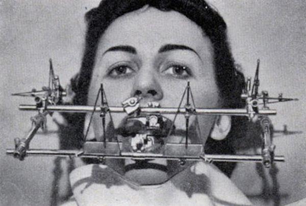 Galvas brekete izmantota tā... Autors: wecazivs 7 senlaicīgi zobārstu instrumenti, kurus tu negribētu