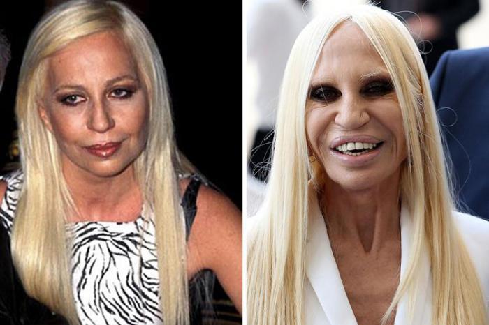 Donatella Versačī Autors: Volāns Sievietes pirms un pēc plastiskās operācijas