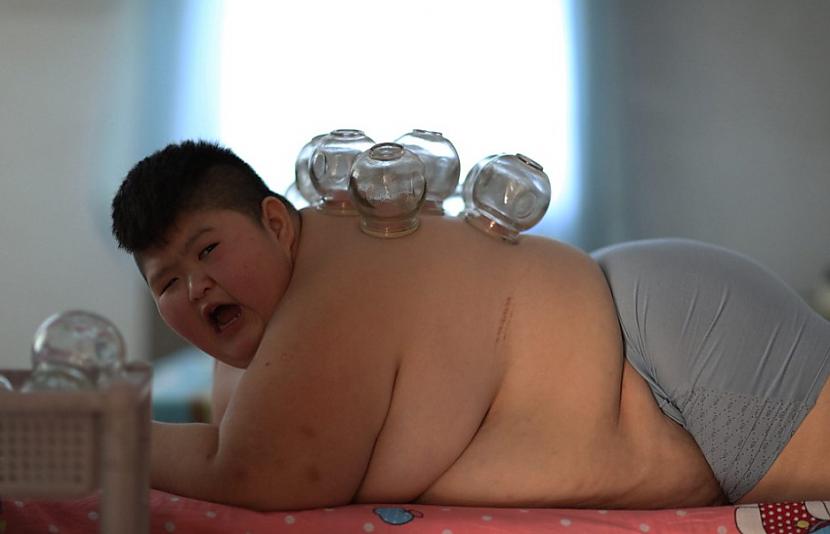 Scaronajā Ķīnas slimnīcā... Autors: matilde 150kg smagais bērns cenšas zaudēt svaru ar uguns palīdzību