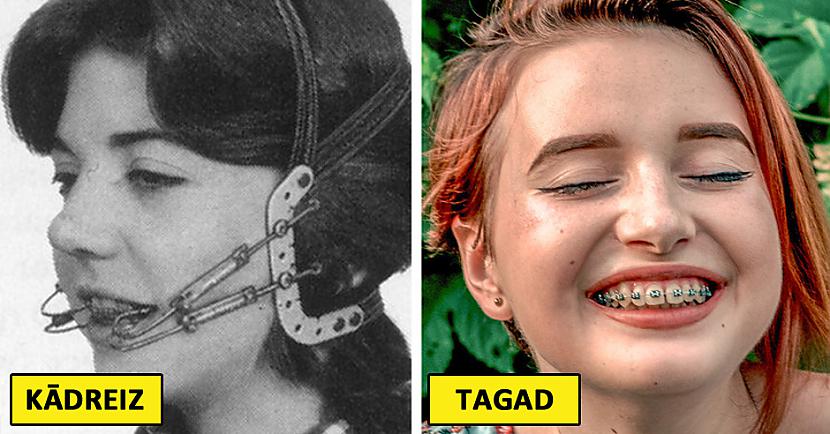 Zobu breketes Autors: matilde Interesanti: Kā 14 skaistumkopšanas lietas izskatījās pirms 100 gadiem