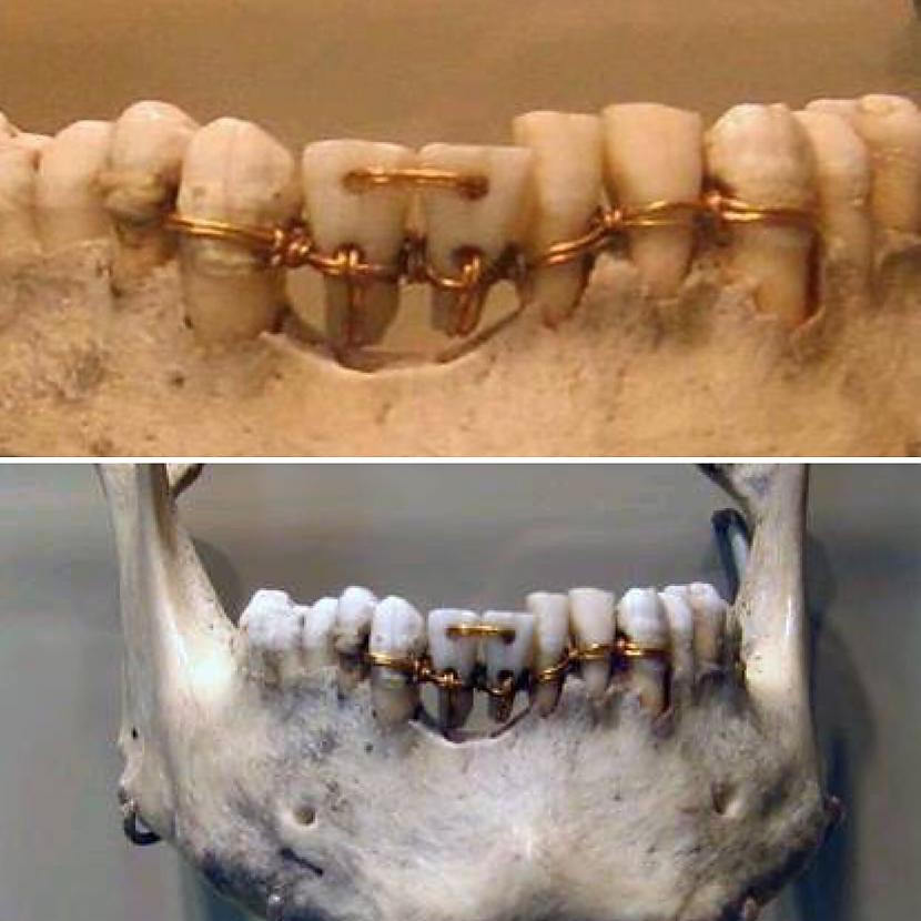 Senās Ēģiptes zobārstniecība... Autors: The Diāna Izglītojoši: Neparasti skeleti, kuri ilustrē slimības un procesus