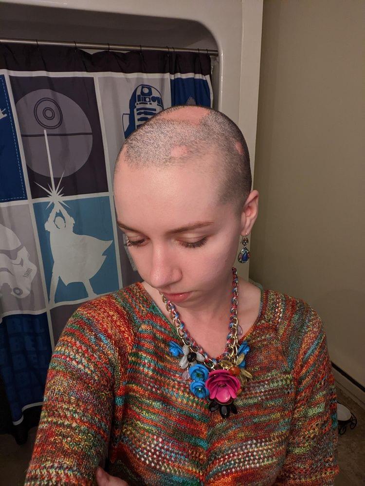 ldquoScaronodien mana alopecia... Autors: Zibenzellis69 Bez sliktajām dienām mēs nepazītu labās, jo tās vienkārši uztvertu kā parastas