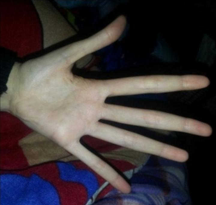 Manas rokas ar Marfana... Autors: Zibenzellis69 18 dīvaini gadījumi, kad ģenētika pārsteidza un deva cilvēkiem neparastu izskatu